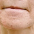 What is the most powerful acne treatment?