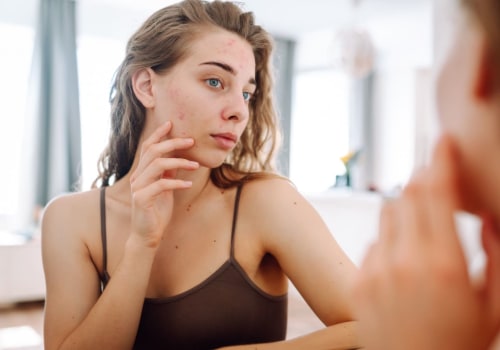 What is the most effective acne remover?